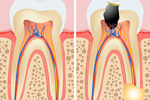 root-canal